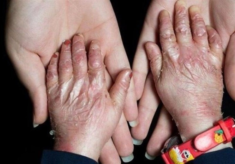 شناسایی ۴۹۲ گونه بیماری نادر در ایران؛ فقط یک‌سوم بیماری‌ها پوشش بیمه سلامت دارند